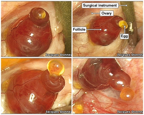 Ovulation, photo of the ovulation moment, the release of an egg from the Graafian follicle captured during the operation